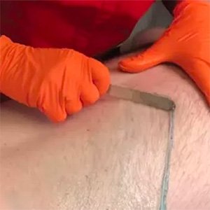 Gentlemen Hair Removal